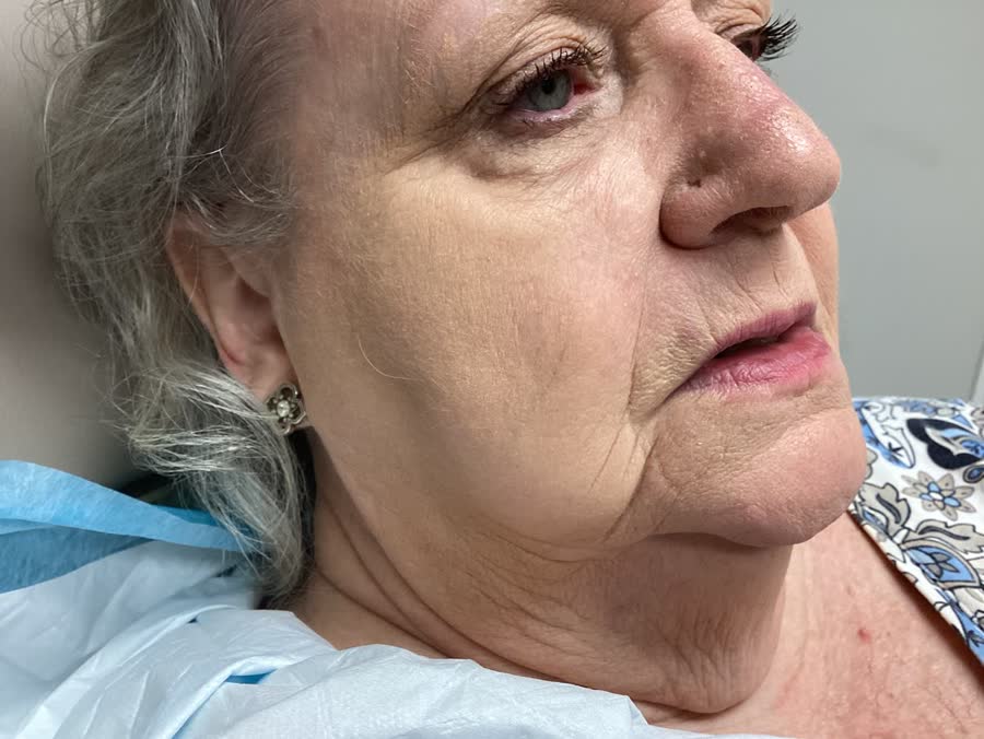Mohs case 1 — Healed: basal cell carcinoma on the right cheek