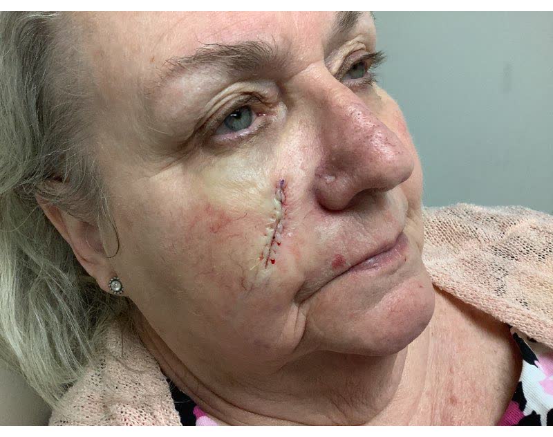 Mohs case 1 — Repair · same day: basal cell carcinoma on the right cheek