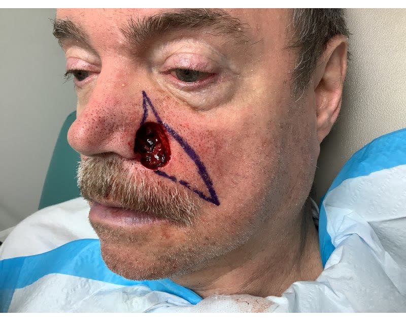 Mohs case 2 — After cancer removal: basal cell carcinoma involving the cheek and nose