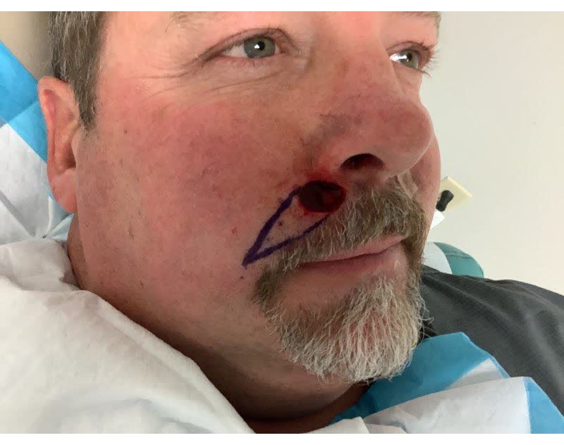Mohs case 3 — After cancer removal: basal cell carcinoma on the right upper lip