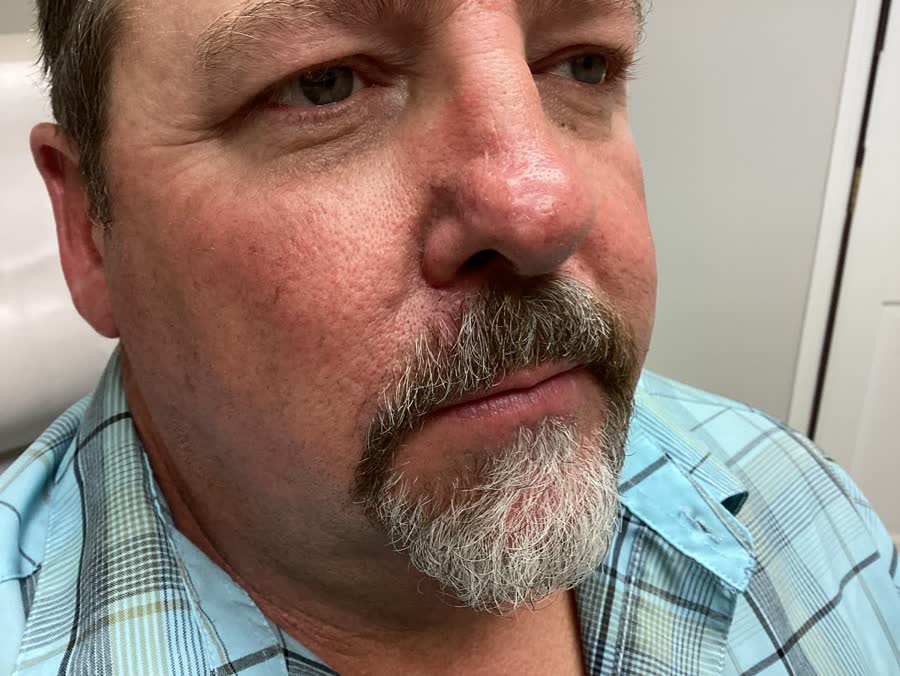 Mohs case 3 — Healed: basal cell carcinoma on the right upper lip