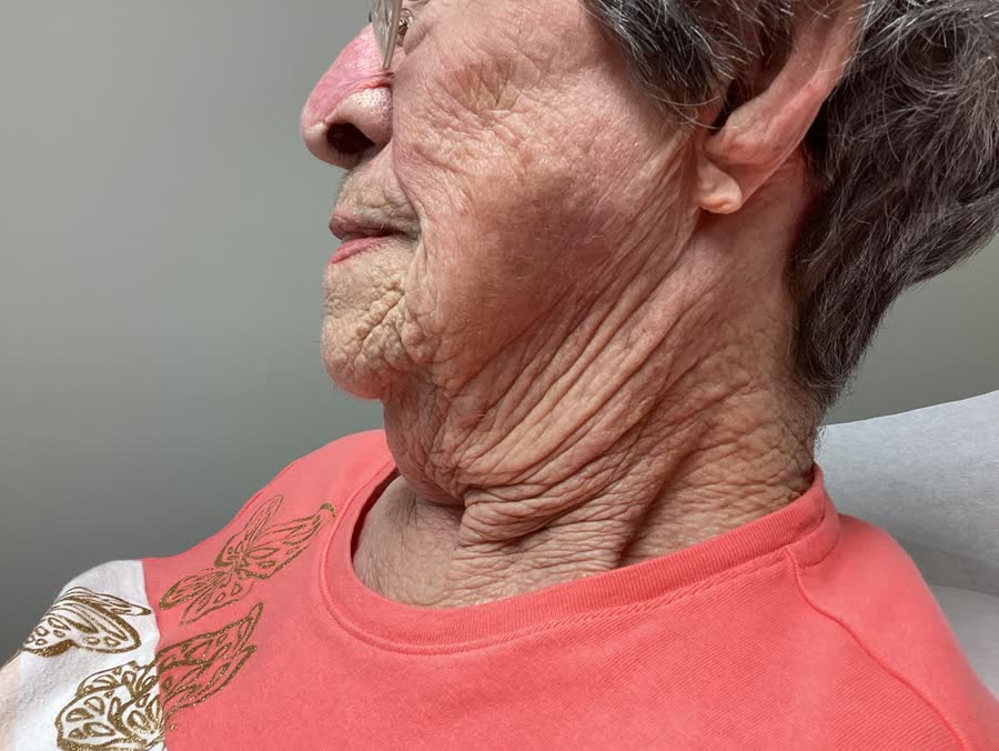 Mohs case 4 — Healed: squamous cell carcinoma on the left cheek