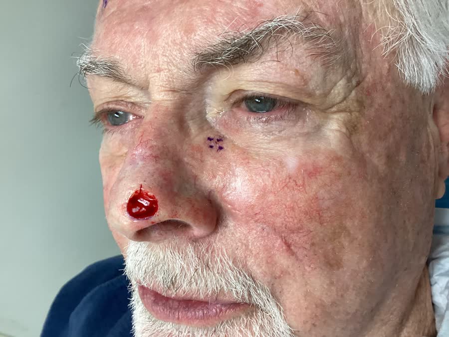 Mohs case 5 — After cancer removal: basal cell carcinoma on the nasal supratip