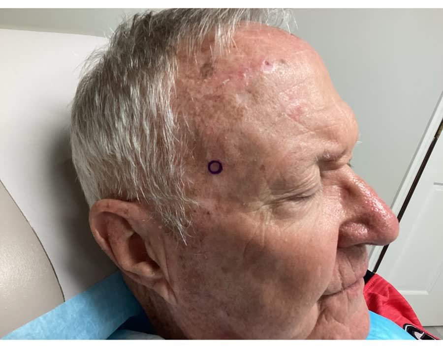Mohs case 6 — Before: squamous cell carcinoma on the right forehead