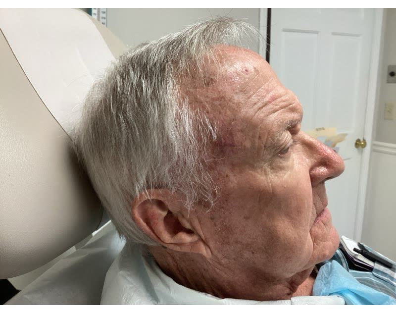 Mohs case 6 — Healed: squamous cell carcinoma on the right forehead