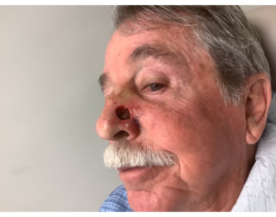 Mohs case 11 — After cancer removal: infiltrative basal cell carcinoma on the nose