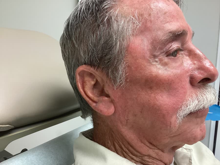 Mohs case 12 — Healed: infiltrative basal cell carcinoma on the right cheek