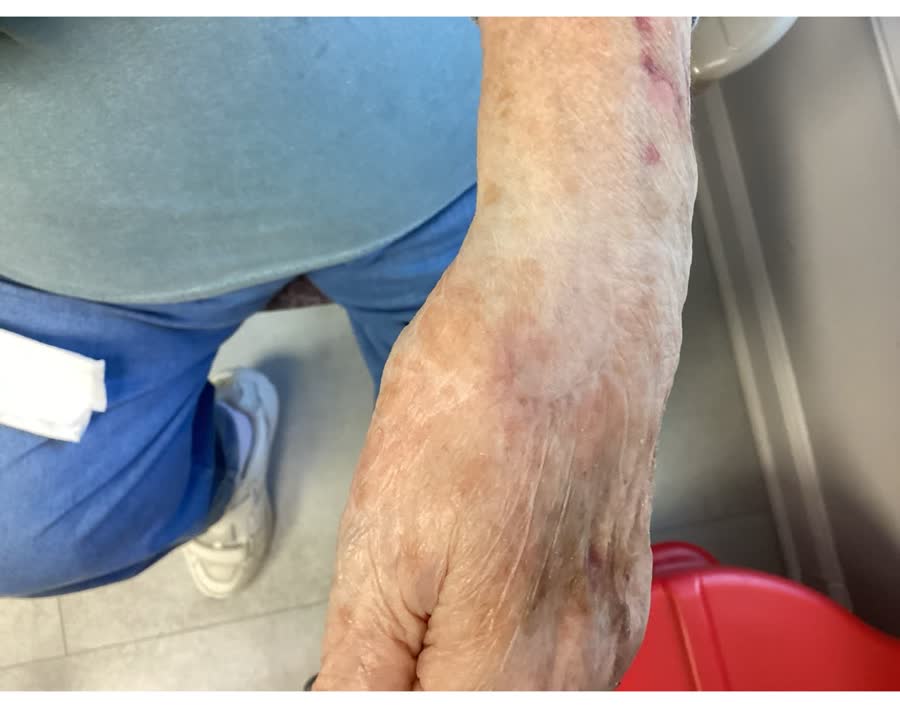 Mohs case 14 — Healed: squamous cell carcinoma on the left hand