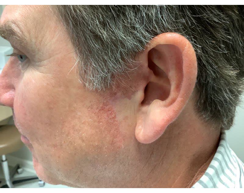 Mohs case 16 — Healed: basal cell carcinoma on the left ear and sideburn