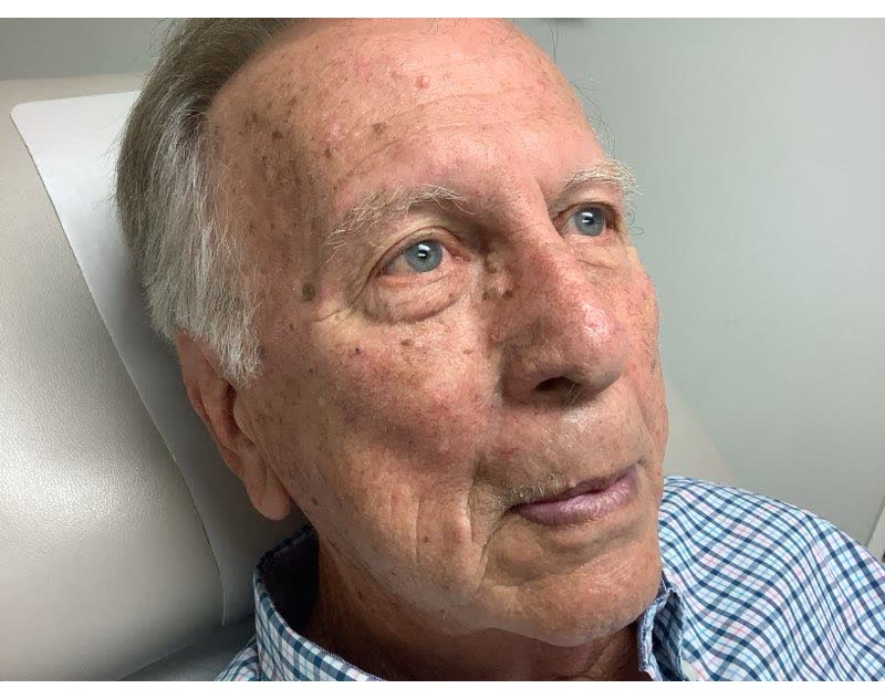 Mohs case 19 — Healed: basal cell carcinoma on the right cheek