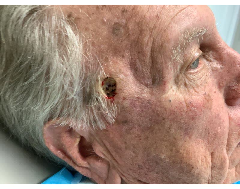 Mohs case 20 — After cancer removal: basosquamous carcinoma on the right temple