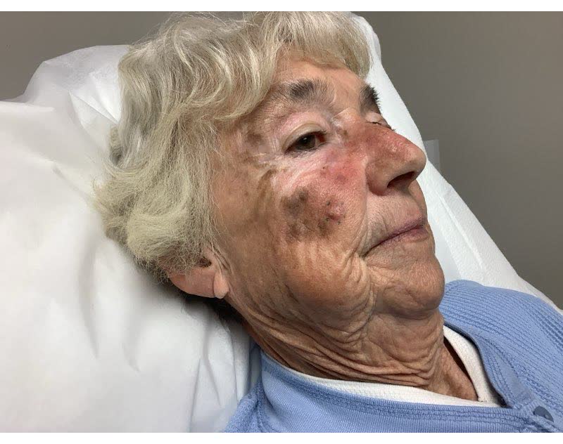 Mohs case 22 — About 1 week after surgery: squamous cell carcinoma on the right cheek