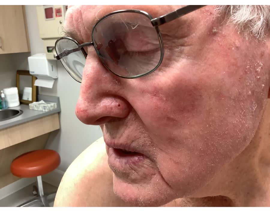 Mohs case 23 — Healed: basal cell carcinoma on the nose repaired with a skin graft