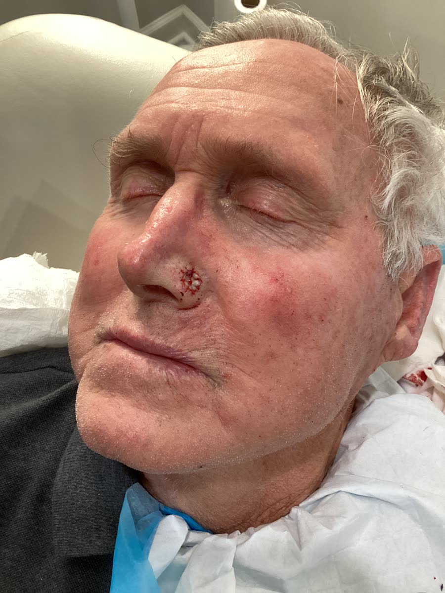 Mohs case 23 — Repair · same day: basal cell carcinoma on the nose repaired with a skin graft